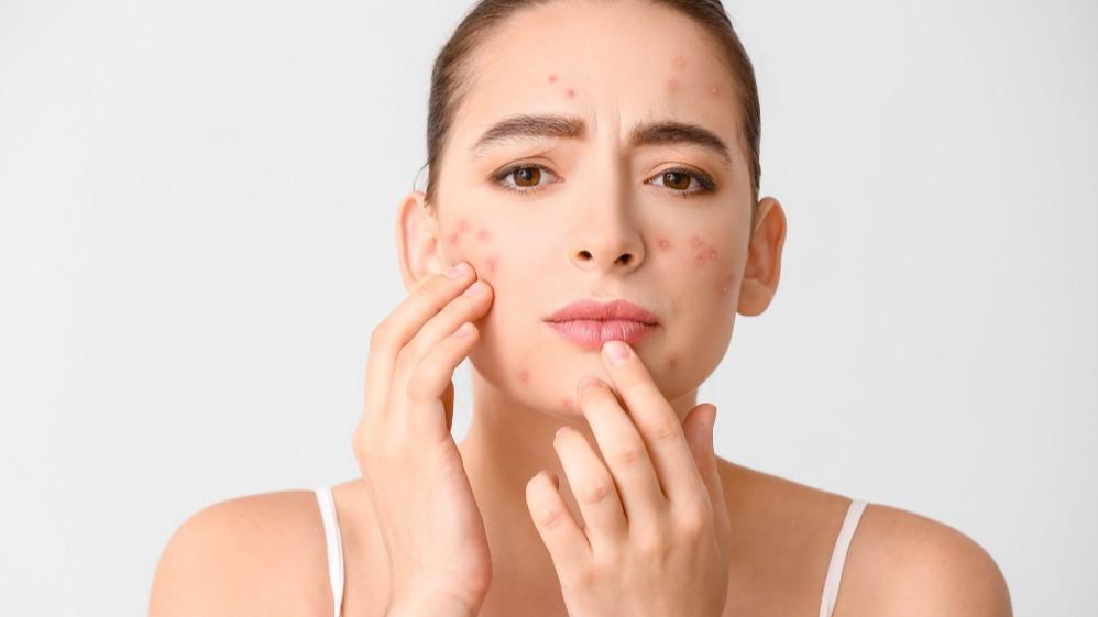 How Are Cystic Acne Treated?